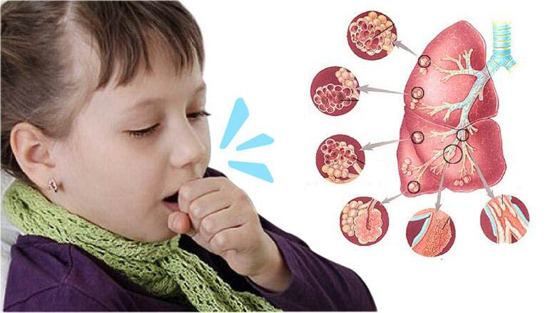 Giai đoạn đầu: Khởi đầu của bệnh có thể không sốt hoặc sốt nhẹ, có viêm long đường hô hấp trên, mệt mỏi, chán ăn và ho.